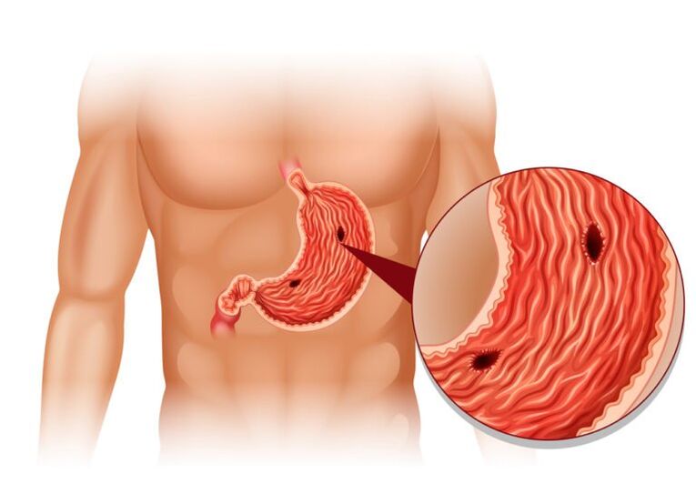 ulcer as the cause of pain under the left shoulder blade behind