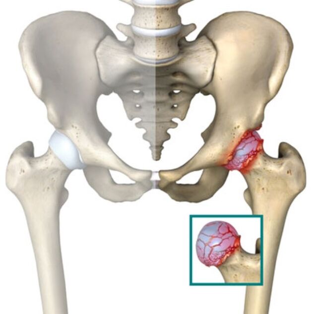 osteoarthritis of the hip joint