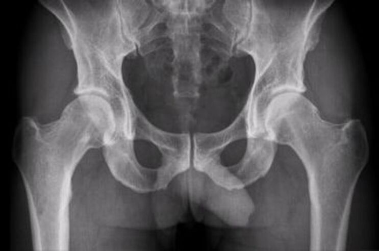 hip joint x-ray for pain