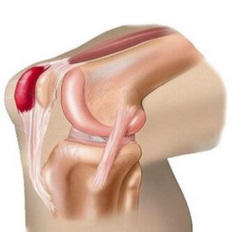 Bursitis is one of the causes of pain in the knee joint. 