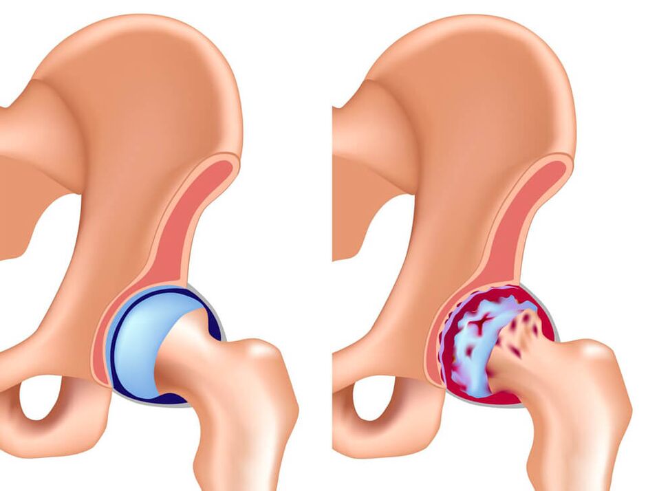 Coxarthrosis is the most common cause of pain in the hip joint. 