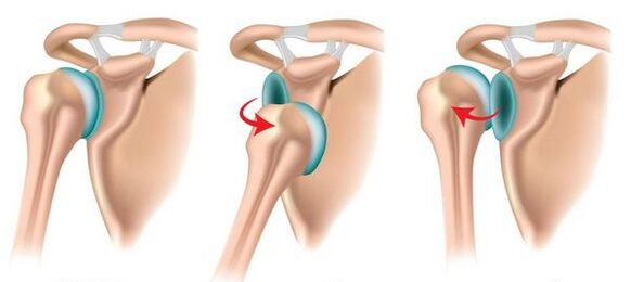 Anterior and posterior dislocation of the shoulder joint, causing the development of osteoarthritis