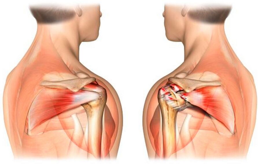 Healthy and arthritic shoulder