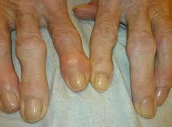 Osteoarthritis of the small joints of the hands hand