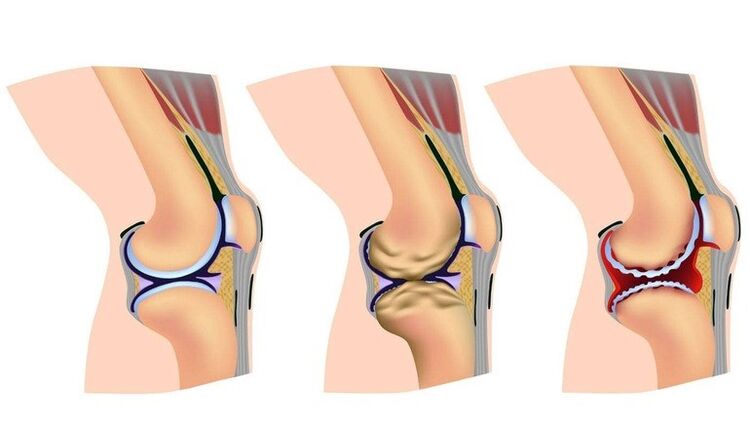 Deformation steps in the knee joint for osteoarthritis