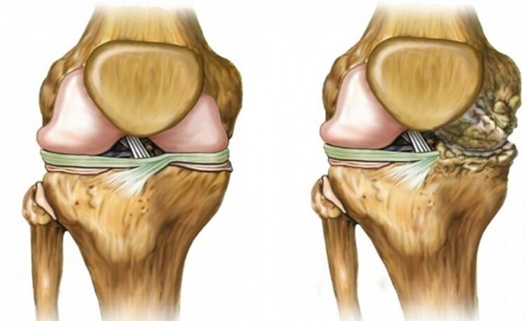 Healthy and affected by the arthritis joint