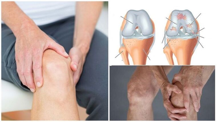 Symptom of knee pain of osteoarthritis of the knee joint