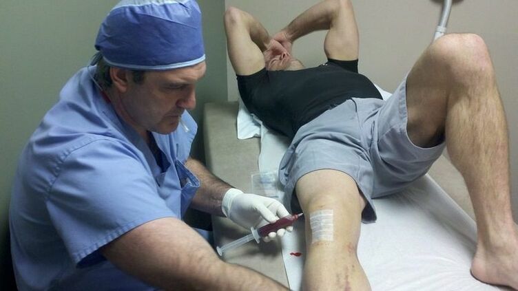 Treatment of osteoarthritis of the knee joint