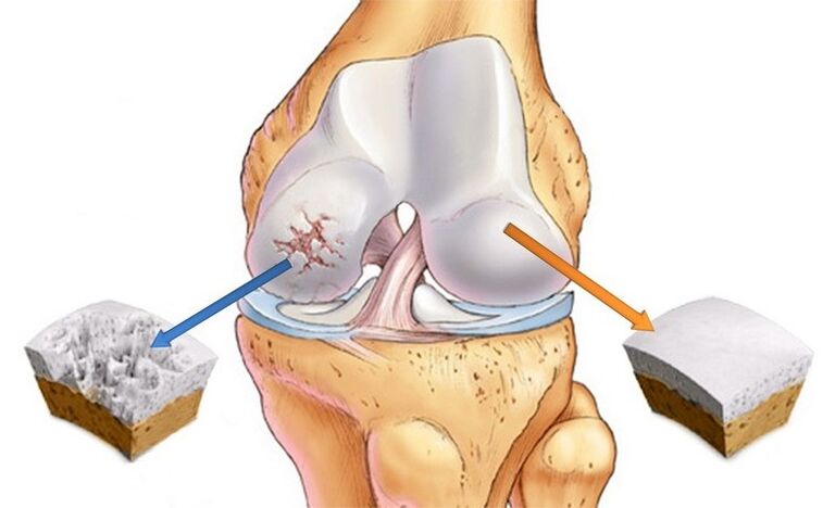 normal cartilage and affected by osteoarthritis