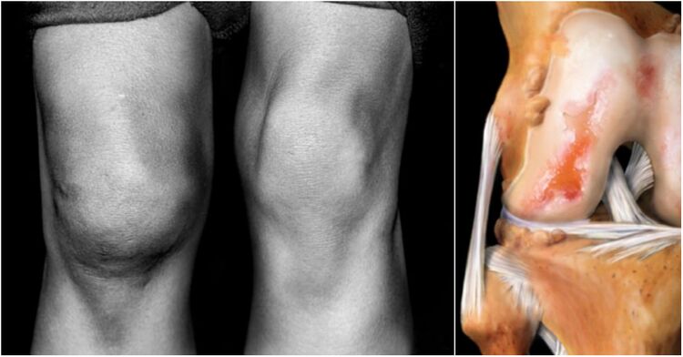 osteoarthritis of the knee joint and endolori joint
