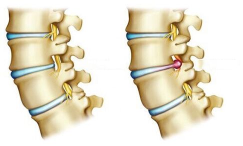 healthy disc and herniated disc