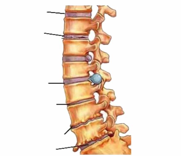 spinal damage leads to back pain