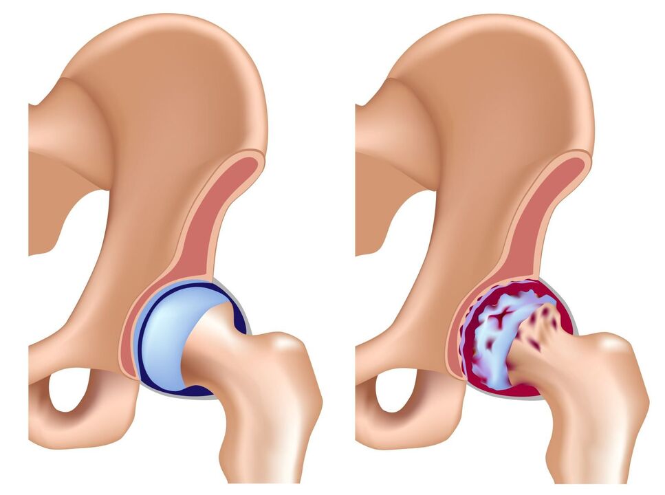 comparison between a healthy joint and osteoarthritis
