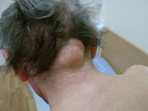 neck swelling as a cause of pain