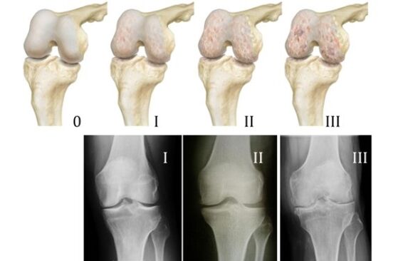 methods of diagnosing knee osteoarthritis