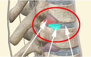 intervertebral hernia