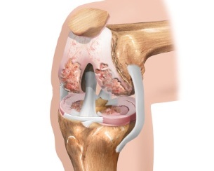 scheme arthrosis